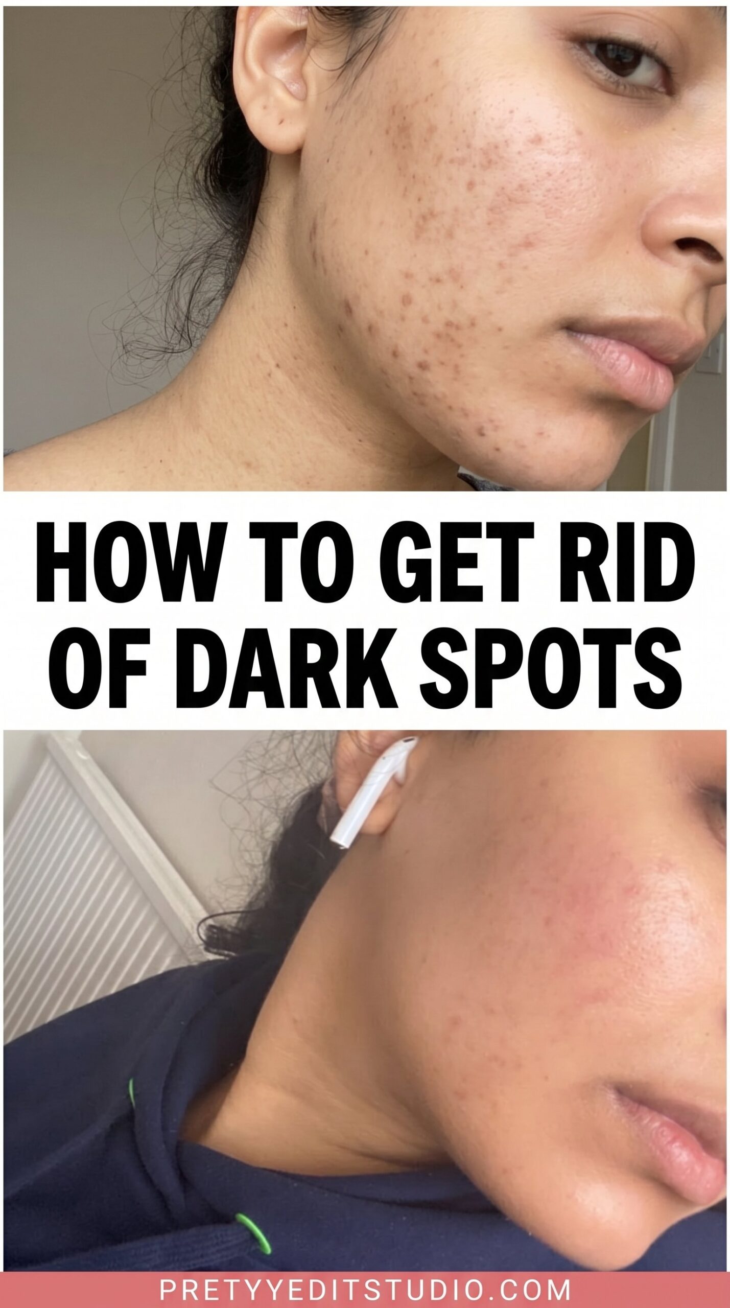 Skincare flatlay for how to get rid of dark spots and hyperpigmentation