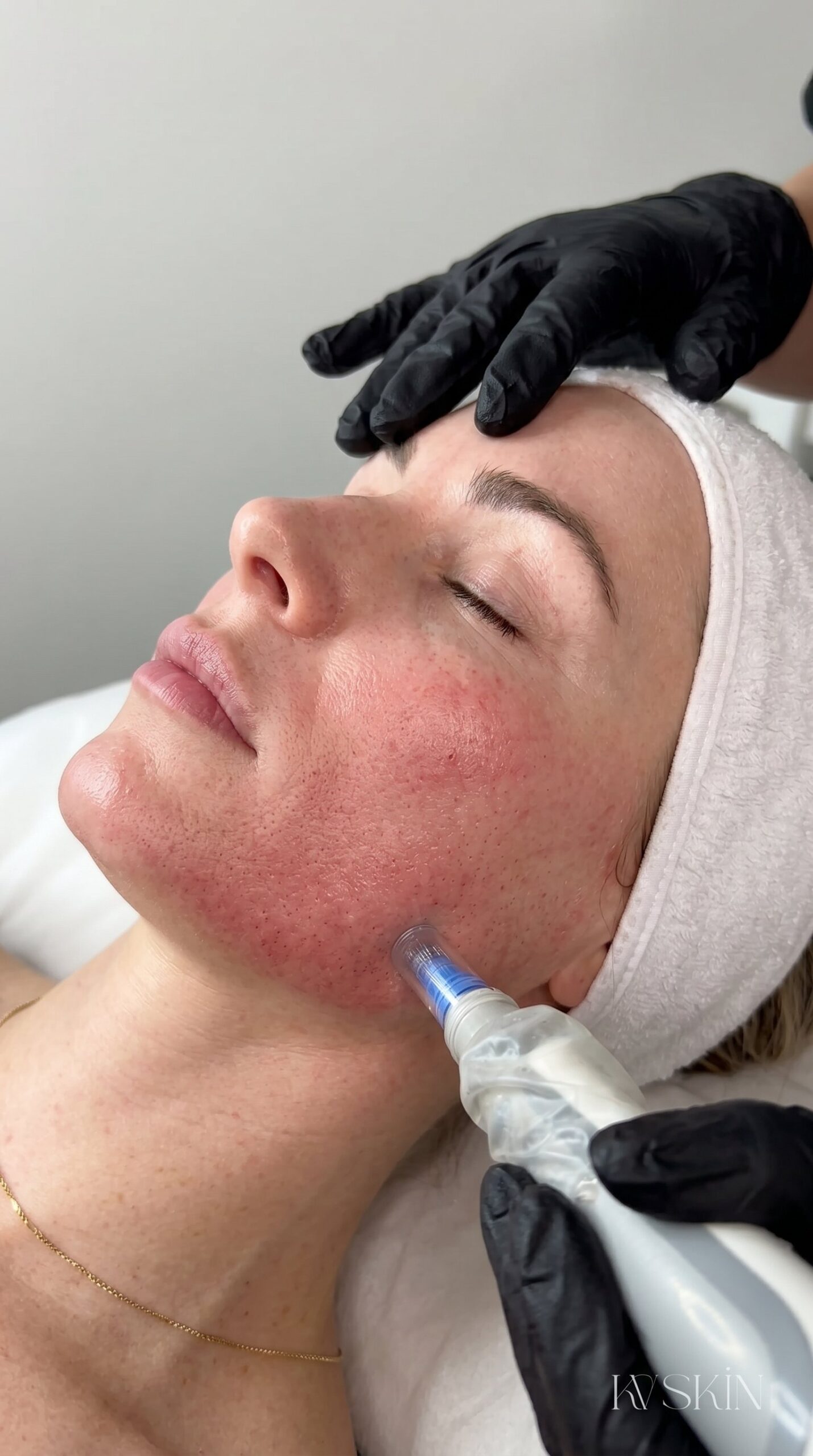 Microneedling treatment for pigmentation and acne scarring